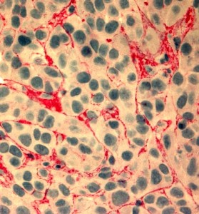 Section from paraffin embedded human melanoma SK-MEL-28 stained with IST-9 mAb.